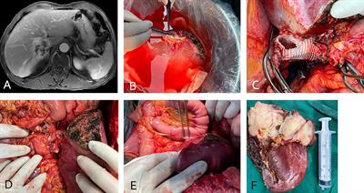 In vivo total or partial hepatectomy followed by ex vivo liver resection and autotransplantation for malignant tumors: a single center experience